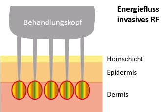 Invasives RF