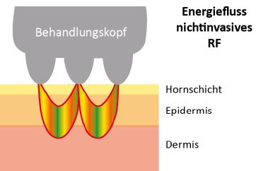 Microneedling